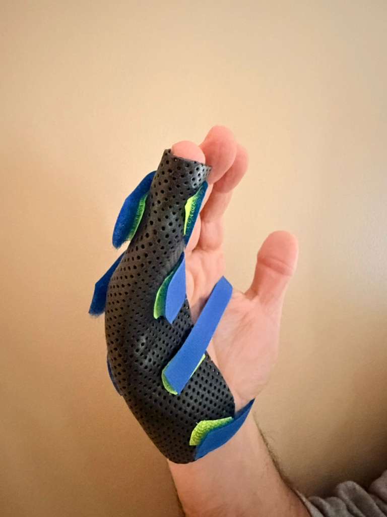 What is the best way to splint a metacarpal fracture?