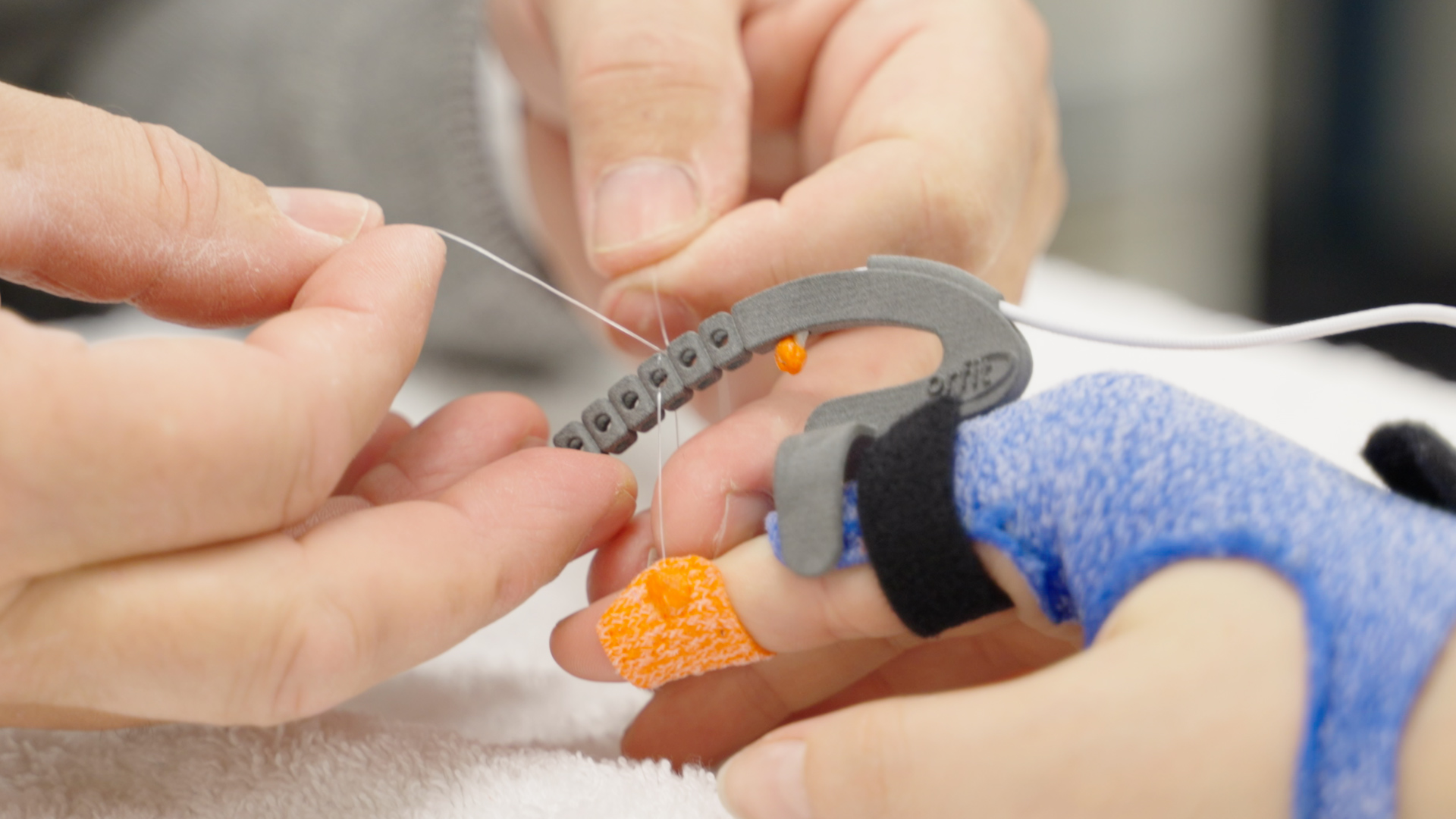 Orthoses to Restore Proximal Interphalangeal (PIP) Joint Motion