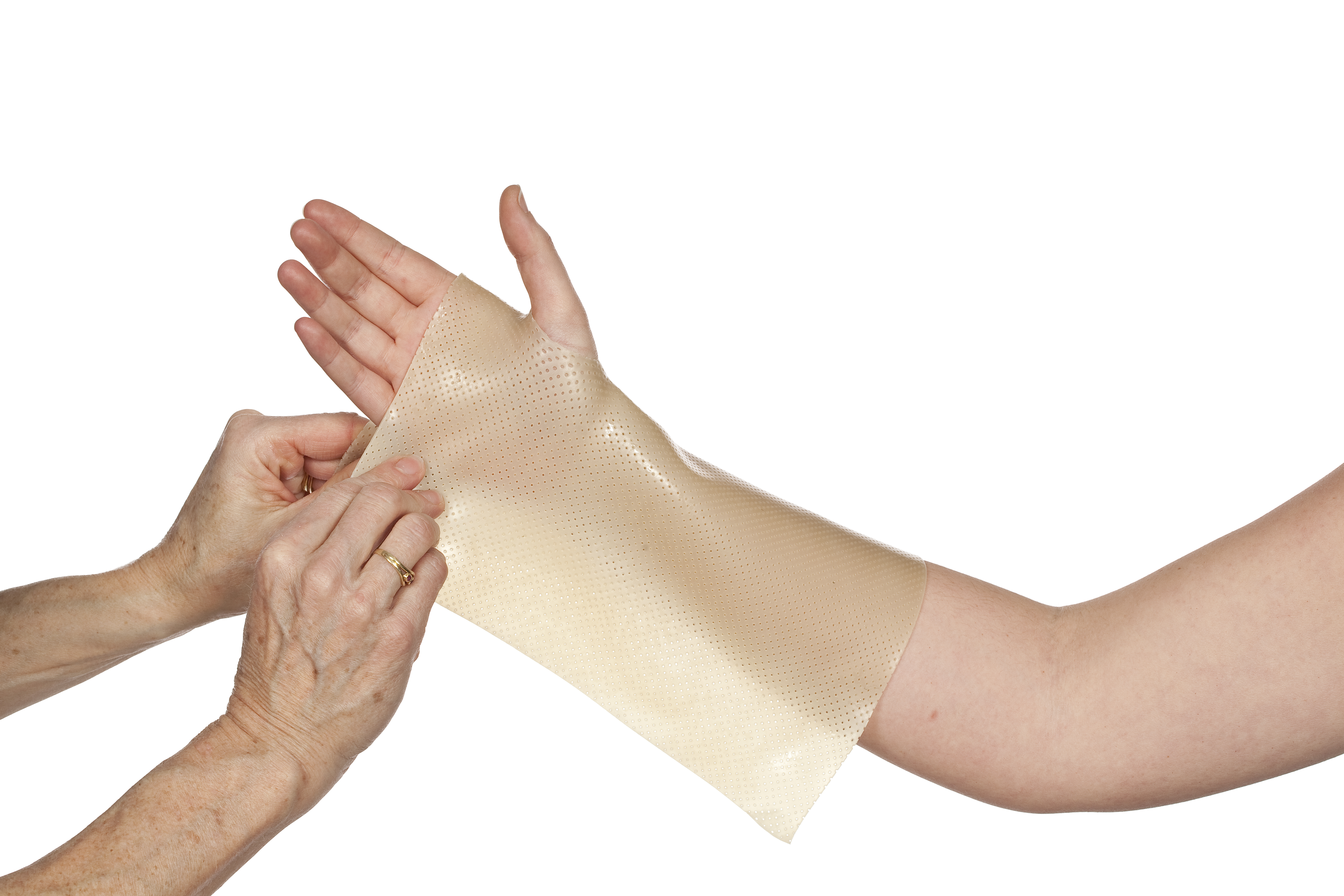 Why orthotic fabrication and hand therapy are so tightly connected